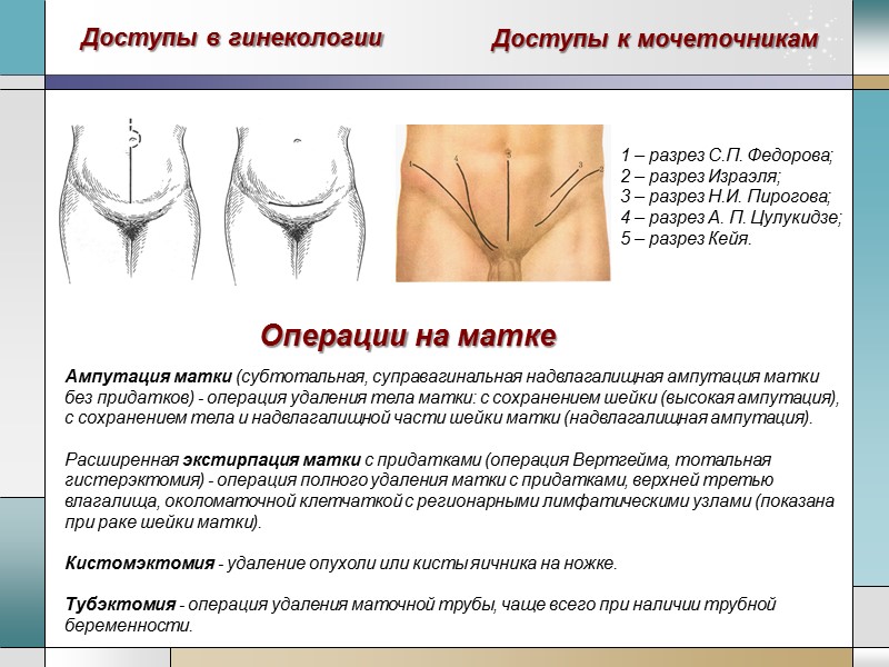 Доступы в гинекологии Ампутация матки (субтотальная, суправагинальная надвлагалищная ампутация матки без придатков) - операция
